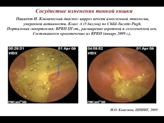 Сосудистые изменения тонкой кишки Пациент И. Клинический диагноз: цирроз печени алкогольной этиологии,