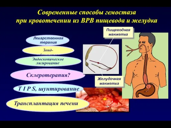 Зонд-обтуратор Современные способы гемостаза при кровотечении из ВРВ пищевода и желудка Лекарственная