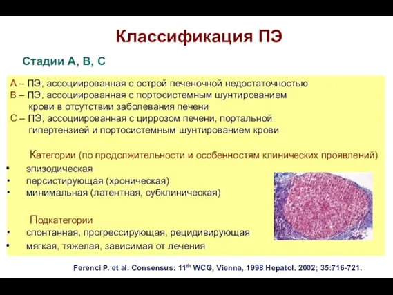 Классификация ПЭ Стадии А, В, С А – ПЭ, ассоциированная с острой