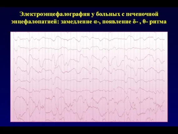 Электроэнцефалография у больных с печеночной энцефалопатией: замедление α-, появление δ- , θ- ритма