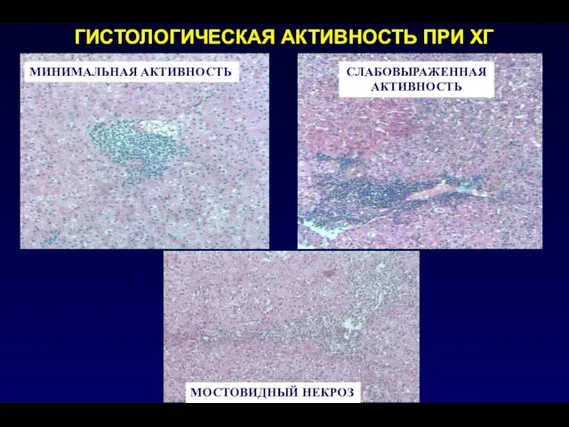 ГИСТОЛОГИЧЕСКАЯ АКТИВНОСТЬ ПРИ ХГ МИНИМАЛЬНАЯ АКТИВНОСТЬ СЛАБОВЫРАЖЕННАЯ АКТИВНОСТЬ МОСТОВИДНЫЙ НЕКРОЗ