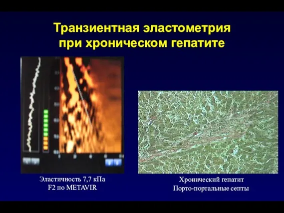 Транзиентная эластометрия при хроническом гепатите Эластичность 7,7 кПа F2 по METAVIR Хронический гепатит Порто-портальные септы