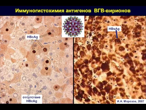 HBcAg HBsAg Иммуногистохимия антигенов ВГВ-вирионов отсутствие HBcAg И.А. Морозов, 2007