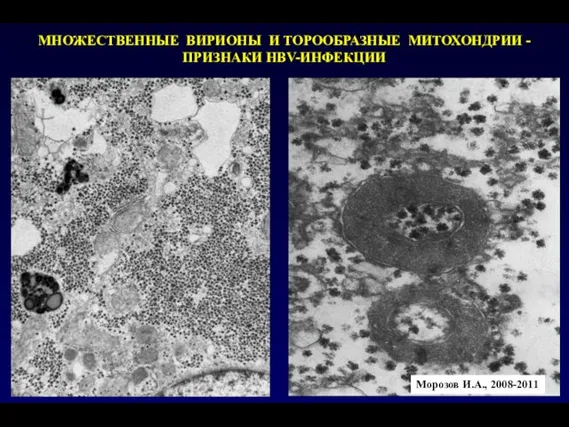 МНОЖЕСТВЕННЫЕ ВИРИОНЫ И ТОРООБРАЗНЫЕ МИТОХОНДРИИ - ПРИЗНАКИ HBV-ИНФЕКЦИИ Морозов И.А., 2008-2011