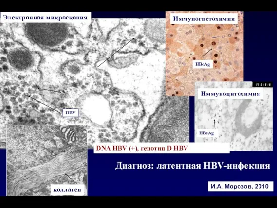 И.А. Морозов, 2010 Электронная микроскопия HBсAg HBV HBsAg DNA HBV (+), генотип