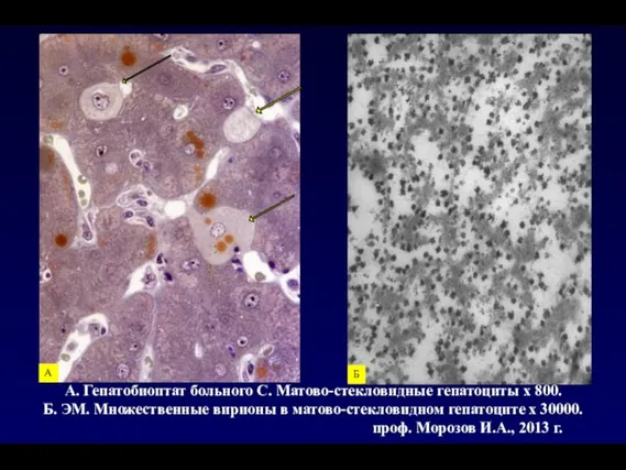 А. Гепатобиоптат больного С. Матово-стекловидные гепатоциты х 800. Б. ЭМ. Множественные вирионы