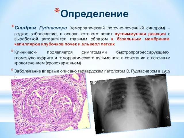 Определение Синдром Гудпасчера (геморрагический легочно-почечный синдром) – редкое заболевание, в основе которого