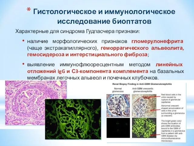 Гистологическое и иммунологическое исследование биоптатов Характерные для синдрома Гудпасчера признаки: наличие морфологических