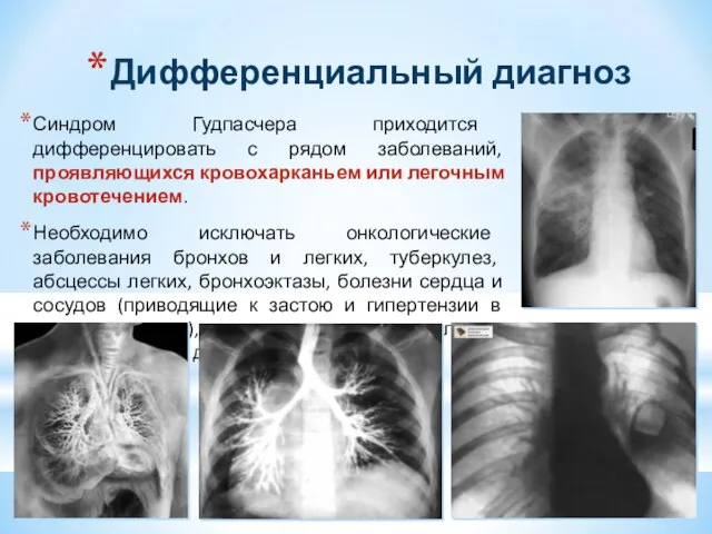 Дифференциальный диагноз Синдром Гудпасчера приходится дифференцировать с рядом заболеваний, проявляющихся кровохарканьем или