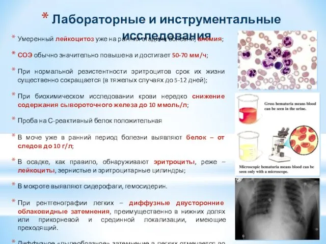 Лабораторные и инструментальные исследования Умеренный лейкоцитоз уже на ранних стадиях болезни, анемия;