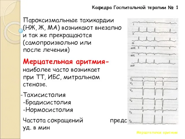 Кафедра Госпитальной терапии № 1 Пароксизмальные тахикардии (НЖ, Ж, МА) возникают внезапно