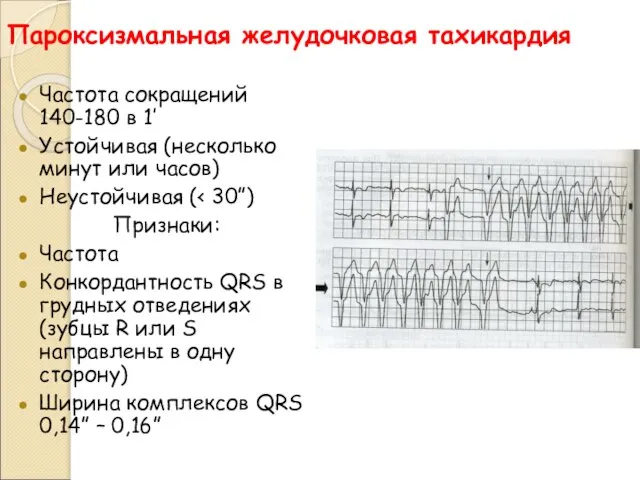 Пароксизмальная желудочковая тахикардия Частота сокращений 140-180 в 1’ Устойчивая (несколько минут или