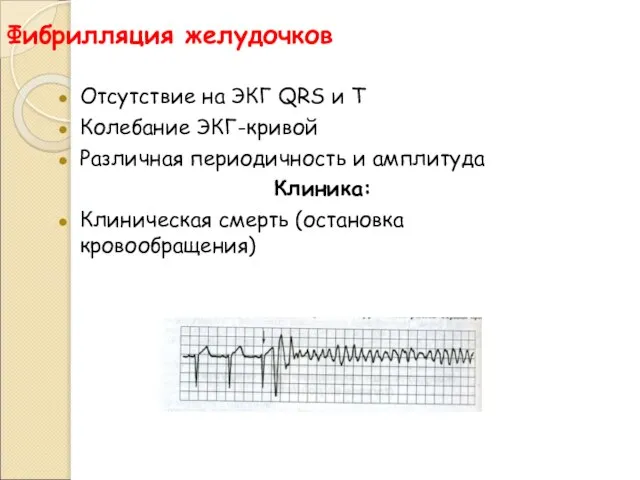 Фибрилляция желудочков Отсутствие на ЭКГ QRS и T Колебание ЭКГ-кривой Различная периодичность