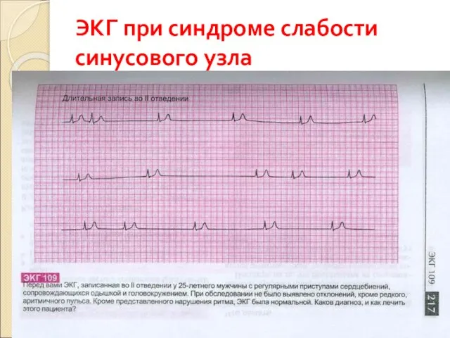 ЭКГ при синдроме слабости синусового узла