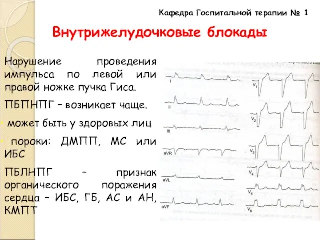 Кафедра Госпитальной терапии № 1 Внутрижелудочковые блокады Нарушение проведения импульса по левой