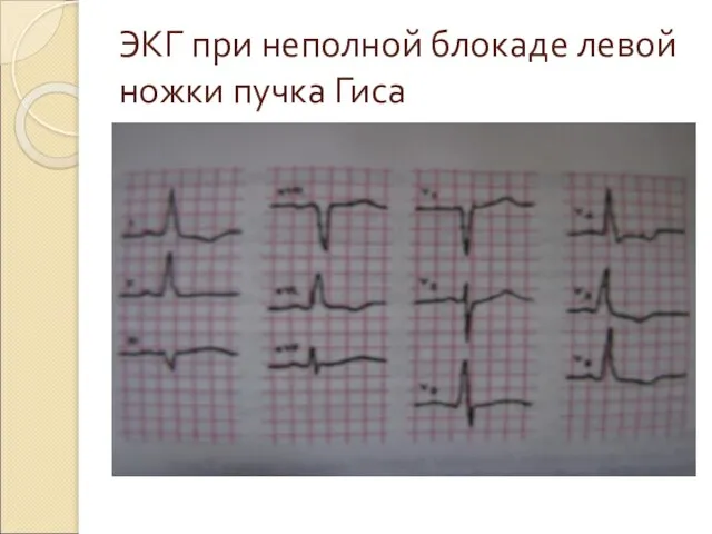 ЭКГ при неполной блокаде левой ножки пучка Гиса