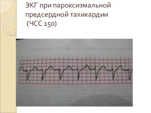 ЭКГ при пароксизмальной предсердной тахикардии (ЧСС 150)