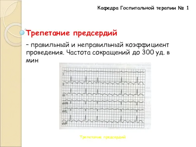 Кафедра Госпитальной терапии № 1 Трепетание предсердий – правильный и неправильный коэффициент