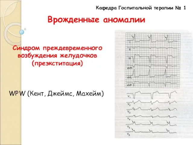 Кафедра Госпитальной терапии № 1 Врожденные аномалии Синдром преждевременного возбуждения желудочков (преэкститация) WPW (Кент, Джеймс, Махейм)