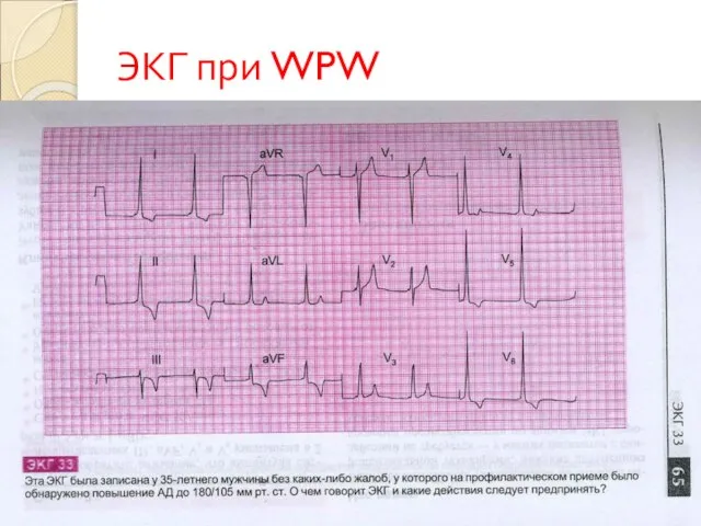 ЭКГ при WPW