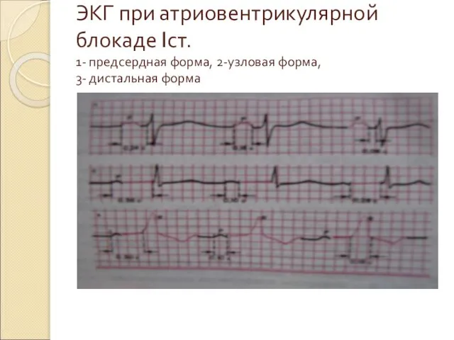 ЭКГ при атриовентрикулярной блокаде Iст. 1- предсердная форма, 2-узловая форма, 3- дистальная форма