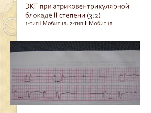 ЭКГ при атриковентрикулярной блокаде II степени (3:2) 1-тип I Мобитца, 2-тип II Мобитца