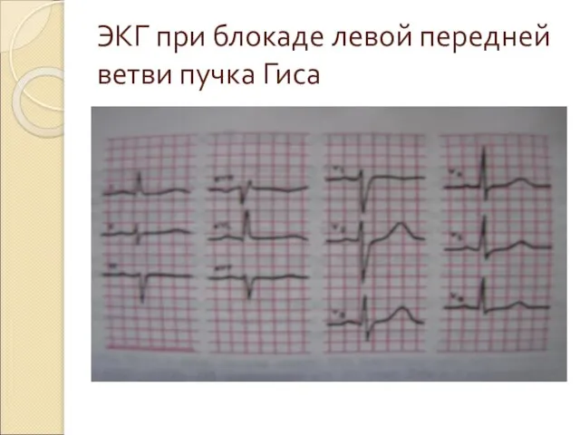 ЭКГ при блокаде левой передней ветви пучка Гиса