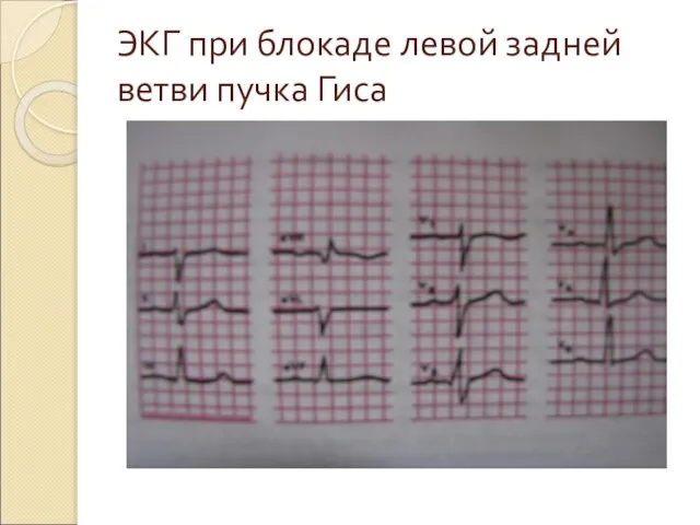 ЭКГ при блокаде левой задней ветви пучка Гиса