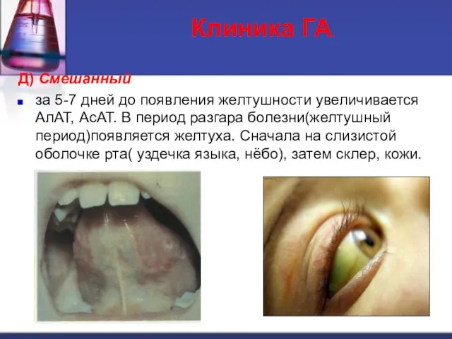 Д) Смешанный за 5-7 дней до появления желтушности увеличивается АлАТ, АсАТ. В