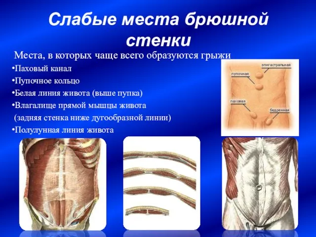 Слабые места брюшной стенки Места, в которых чаще всего образуются грыжи Паховый