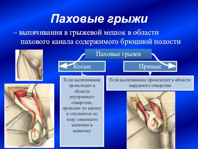 Паховые грыжи – выпячивания в грыжевой мешок в области пахового канала содержимого