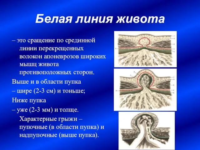 Белая линия живота – это сращение по срединной линии перекрещенных волокон апоневрозов