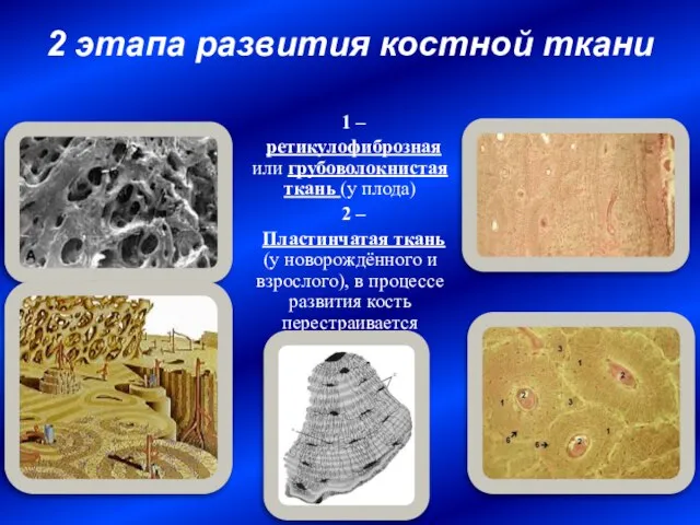 2 этапа развития костной ткани 1 – ретикулофиброзная или грубоволокнистая ткань (у