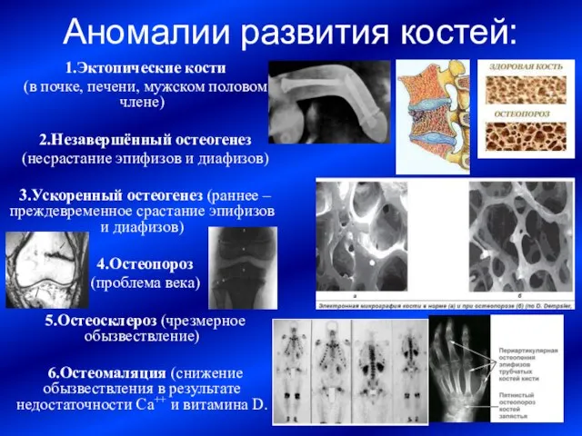 Аномалии развития костей: 1.Эктопические кости (в почке, печени, мужском половом члене) 2.Незавершённый