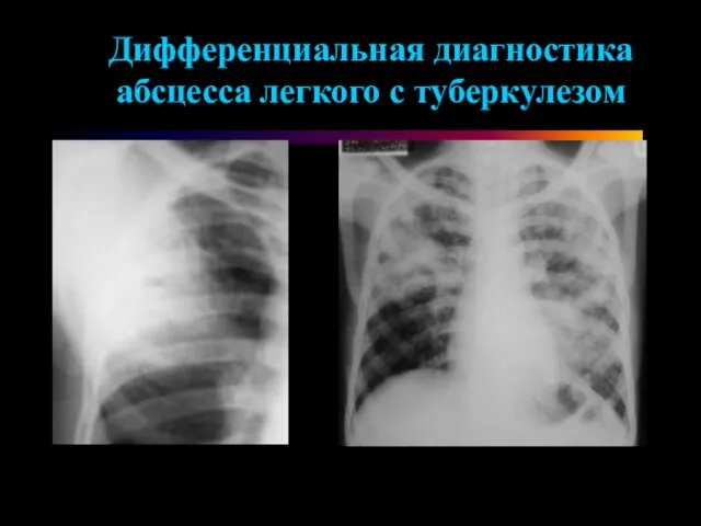 Дифференциальная диагностика абсцесса легкого с туберкулезом