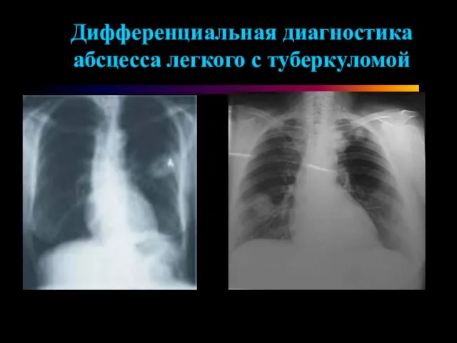 Дифференциальная диагностика абсцесса легкого с туберкуломой
