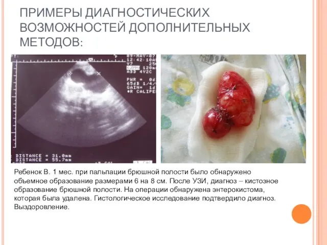 ПРИМЕРЫ ДИАГНОСТИЧЕСКИХ ВОЗМОЖНОСТЕЙ ДОПОЛНИТЕЛЬНЫХ МЕТОДОВ: Ребенок В. 1 мес. при пальпации брюшной