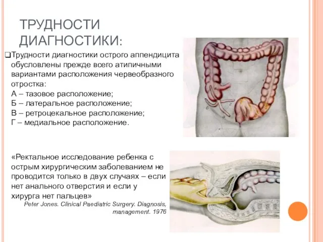ТРУДНОСТИ ДИАГНОСТИКИ: Трудности диагностики острого аппендицита обусловлены прежде всего атипичными вариантами расположения