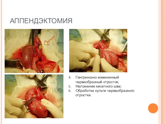 АППЕНДЭКТОМИЯ Гангренозно измененный червеобразный отросток; Наложение кисетного шва; Обработка культи червеобразного отростка.