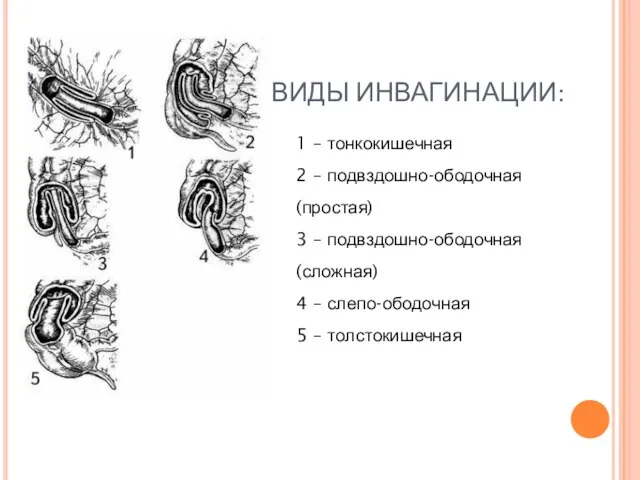 ВИДЫ ИНВАГИНАЦИИ: 1 – тонкокишечная 2 – подвздошно-ободочная (простая) 3 – подвздошно-ободочная