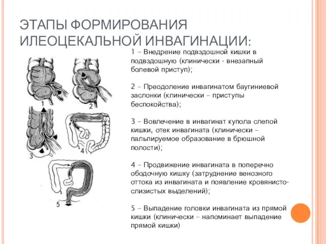 ЭТАПЫ ФОРМИРОВАНИЯ ИЛЕОЦЕКАЛЬНОЙ ИНВАГИНАЦИИ: 1 – Внедрение подвздошной кишки в подвздошную (клинически