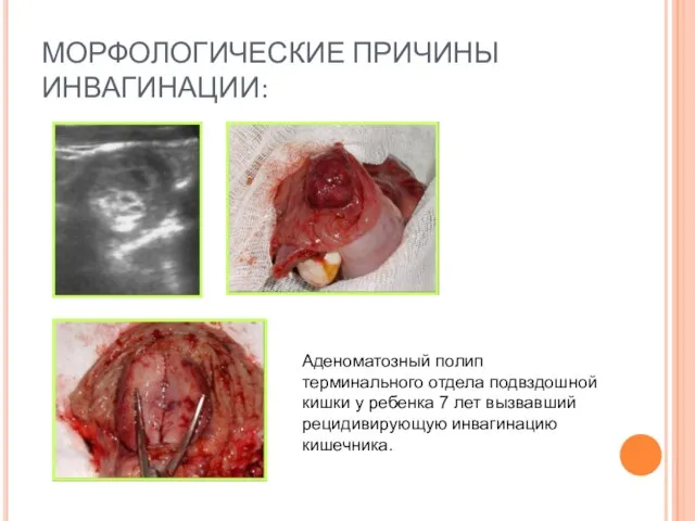 МОРФОЛОГИЧЕСКИЕ ПРИЧИНЫ ИНВАГИНАЦИИ: Аденоматозный полип терминального отдела подвздошной кишки у ребенка 7
