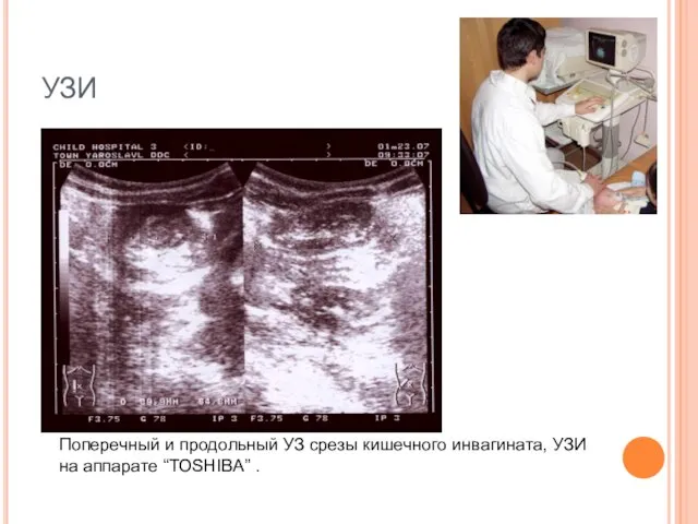 УЗИ Поперечный и продольный УЗ срезы кишечного инвагината, УЗИ на аппарате “TOSHIBA” .