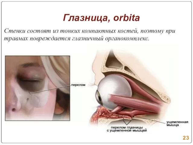 Глазница, orbita Стенки состоят из тонких компактных костей, поэтому при травмах повреждается глазничный органокомплекс.