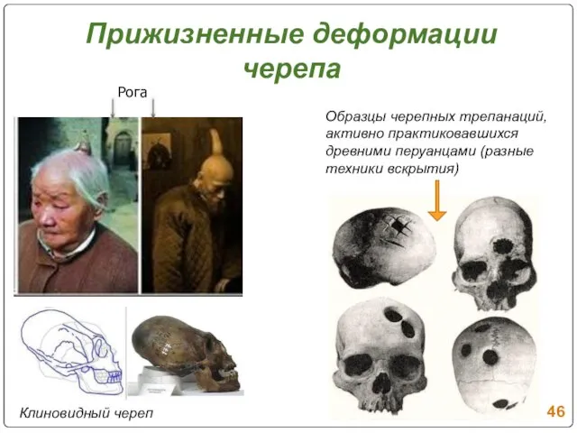 Прижизненные деформации черепа Образцы черепных трепанаций, активно практиковавшихся древними перуанцами (разные техники вскрытия) Рога Клиновидный череп