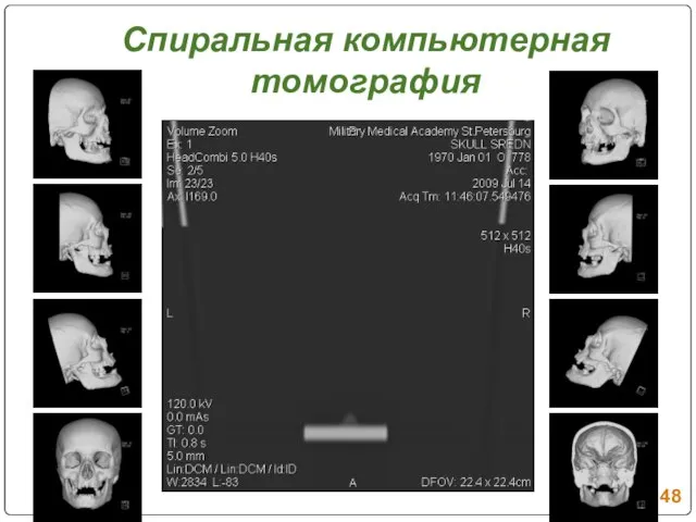 Спиральная компьютерная томография