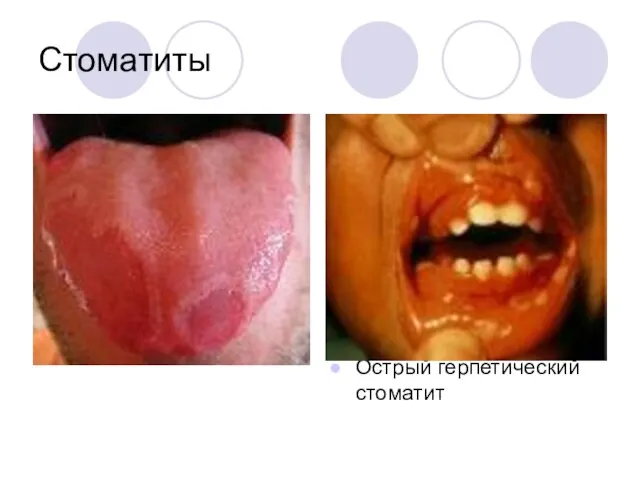 Стоматиты Острый герпетический стоматит