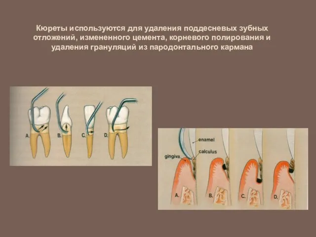 Кюреты используются для удаления поддесневых зубных отложений, измененного цемента, корневого полирования и