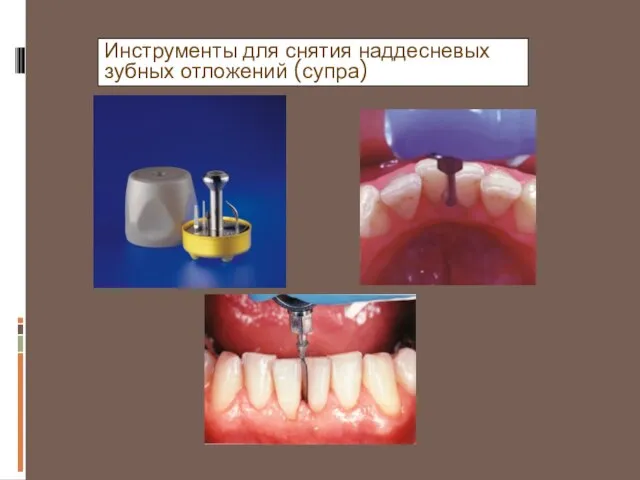 Инструменты для снятия наддесневых зубных отложений (супра)