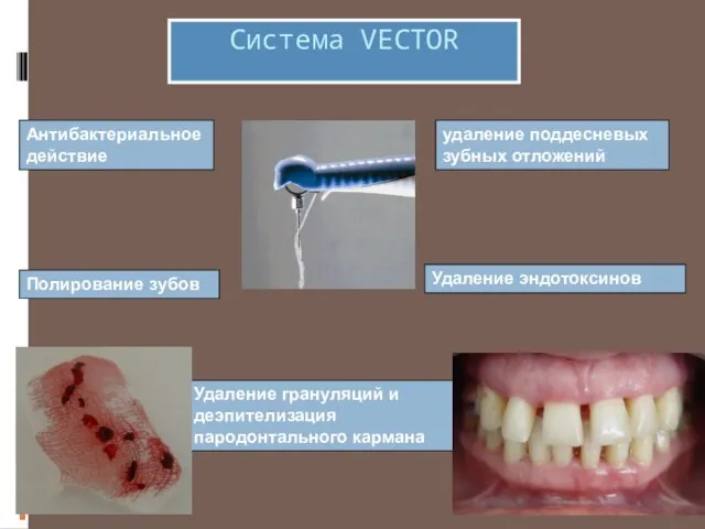 Система VECTOR удаление поддесневых зубных отложений Антибактериальное действие Удаление эндотоксинов Полирование зубов